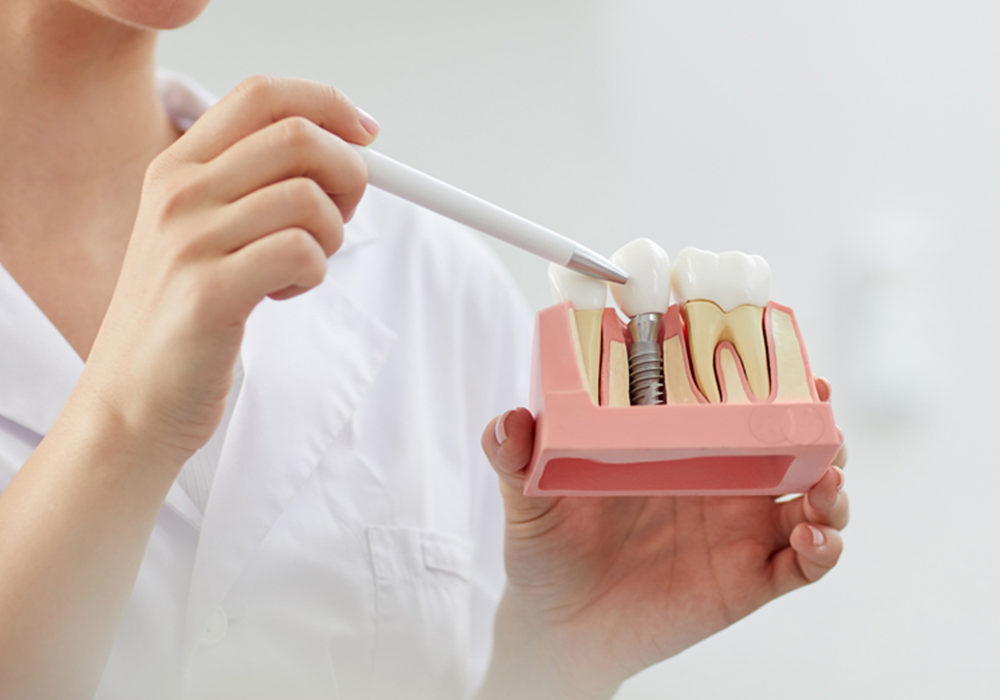 cos'è l'implantologia a carico immediato, studio dentistico petreni bianciardi