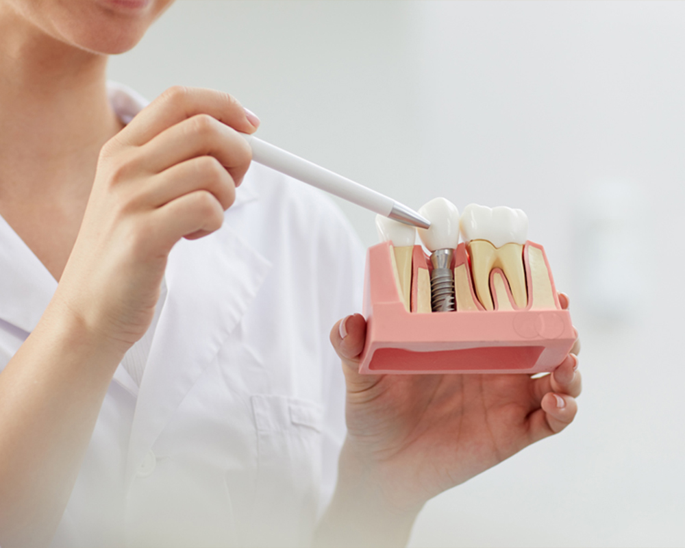 cos'è l'implantologia a carico immediato, studio dentistico petreni bianciardi