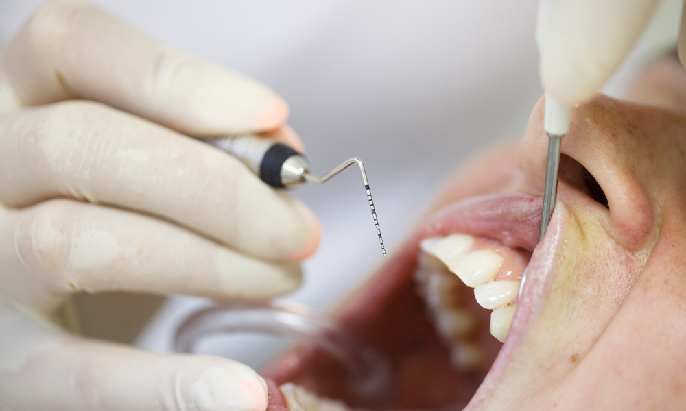 Clinica dentale a Grosseto, studio Petreni Bianciardi - Parodontite causa e cura (2)