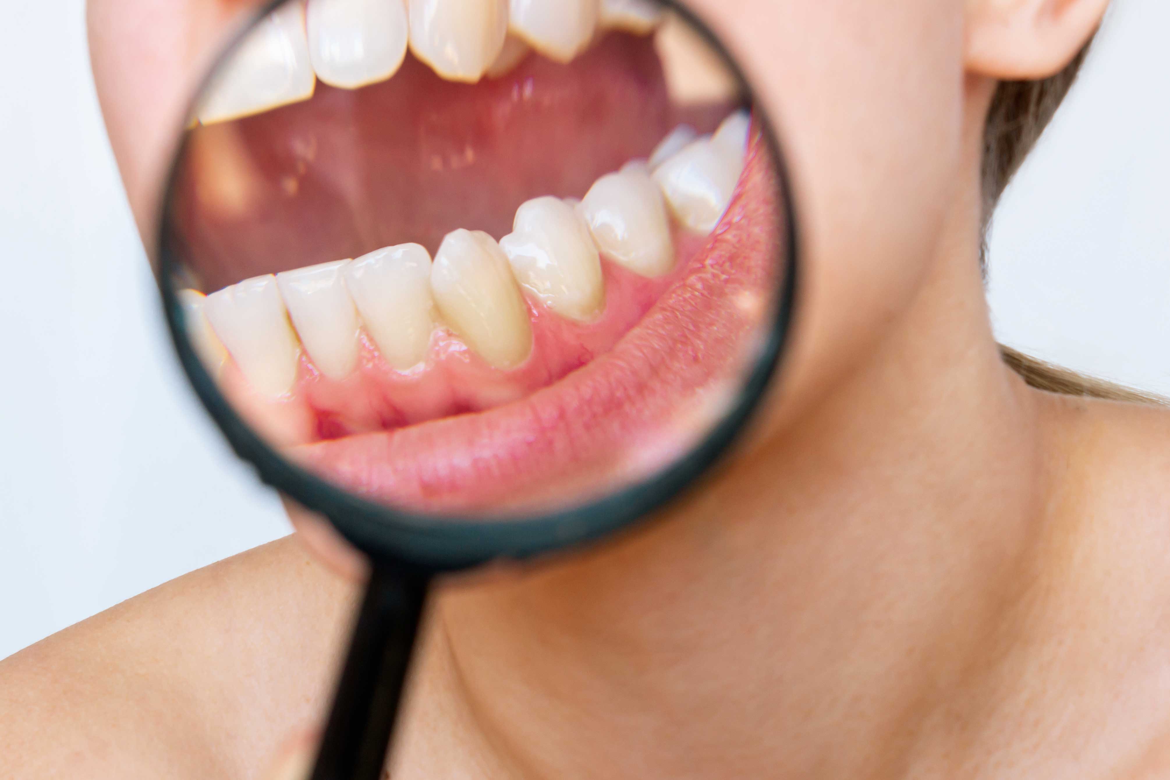 clinica dentale a Grosseto parodontite cause e cura