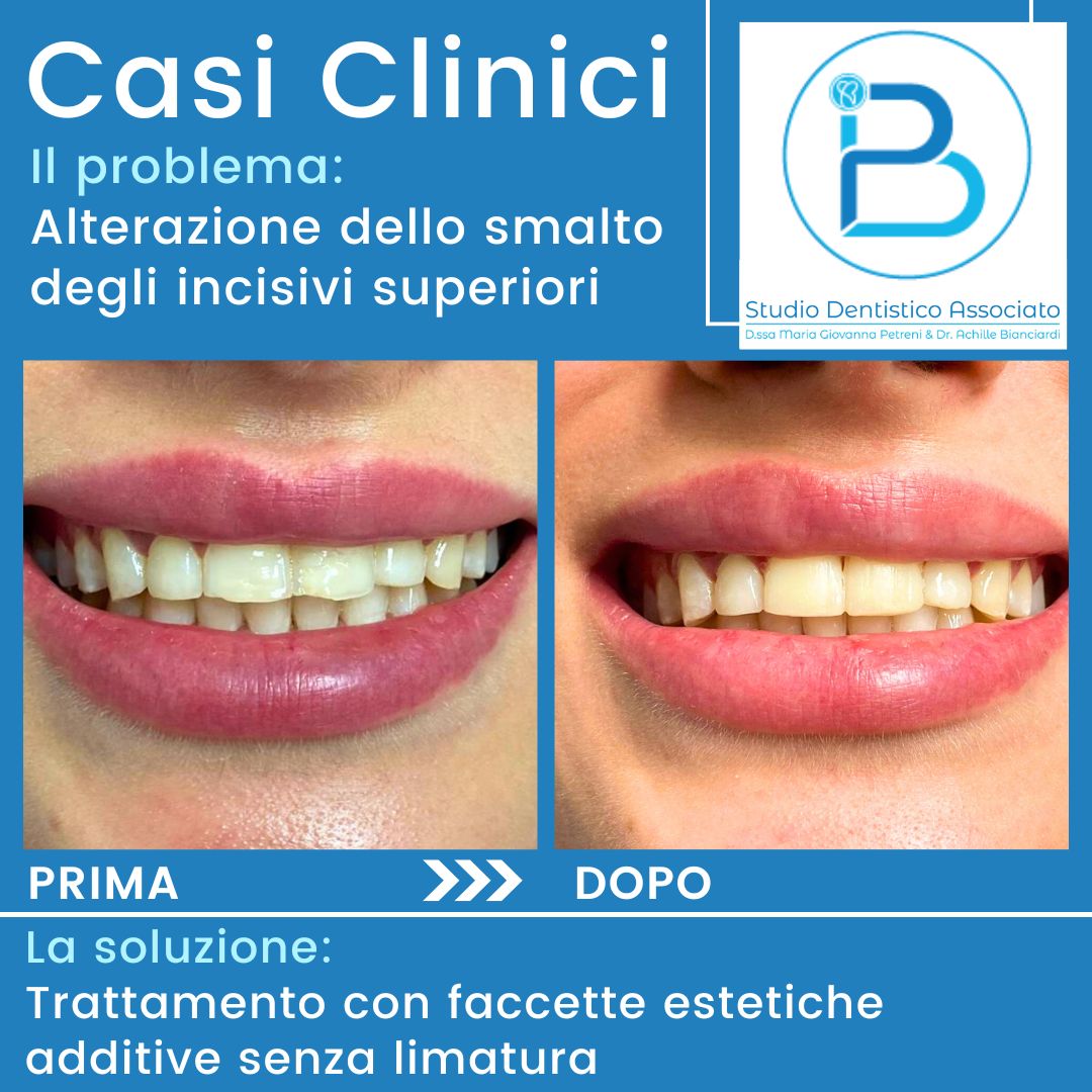 Casi clinici Alterazione dello smalto - Studio Dentistico Petreni Bianciardi