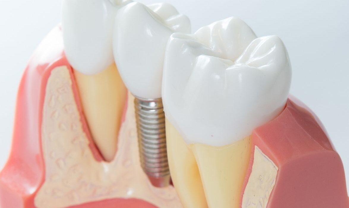 Impantologia Dentale a Grosseto Petreni e Bianciardi