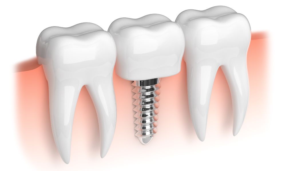 Impianti a carico immediato Studio Dentistico Petreni Bianciardi