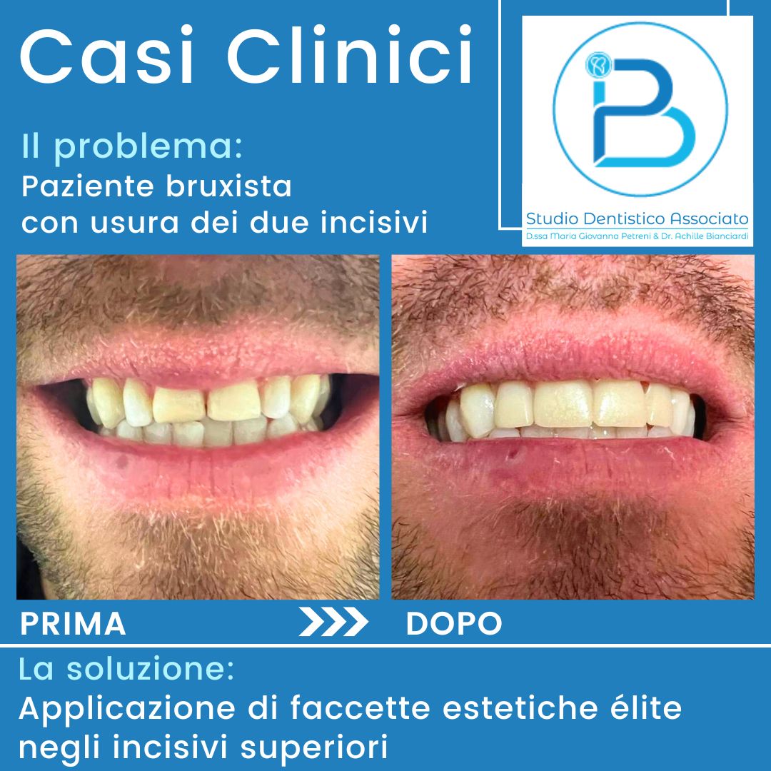 Bruxismo-e-faccette-estetiche-Studio-Petreni-Bianciardi