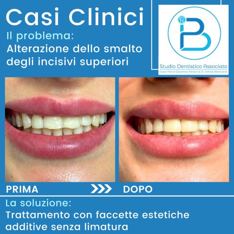 Casi-clinici-Alterazione-dello-smalto-Studio-Dentistico-Petreni-Bianciardi