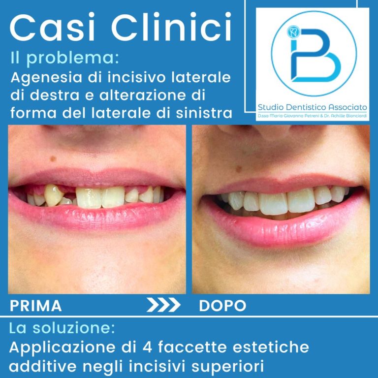 Casi-clinici-paziente-con-agenesia-di-incisivo-laterale-e-alterazione-di-forma
