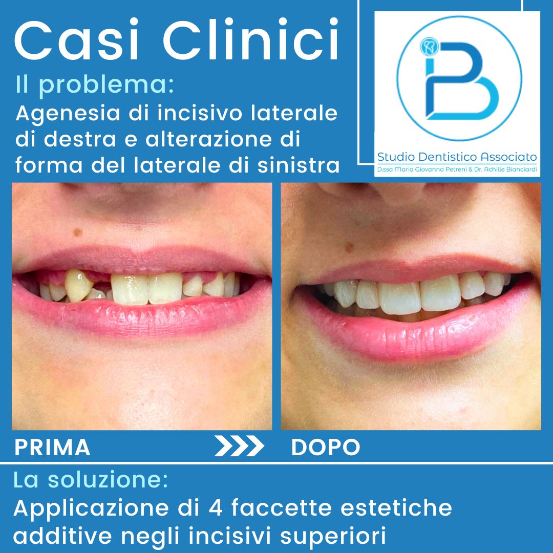 Casi-clinici-paziente-con-agenesia-di-incisivo-laterale-e-alterazione-di-forma