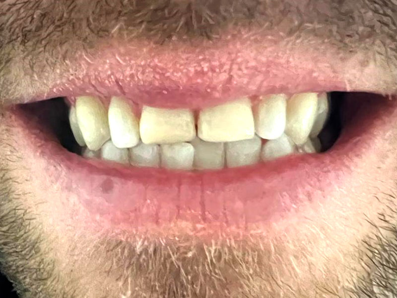 bruxismo-e-faccette-caso-clinico-paziente-prima-Petreni-e-Bianciardi
