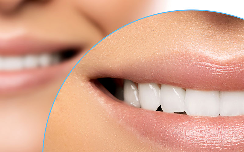 Sbiancamento-Notturno-a-Grosseto-Studio-dentistico-Petreni-Bianciardi